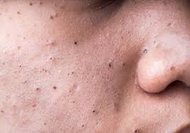 Blackheads & Whiteheads: How to Avoid and Remove Them.